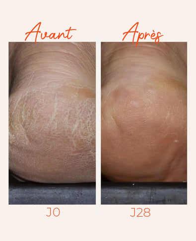 Alvadiem Intense Dry & Fragilized Feet Protective Treatment Foot Cream 100 ml