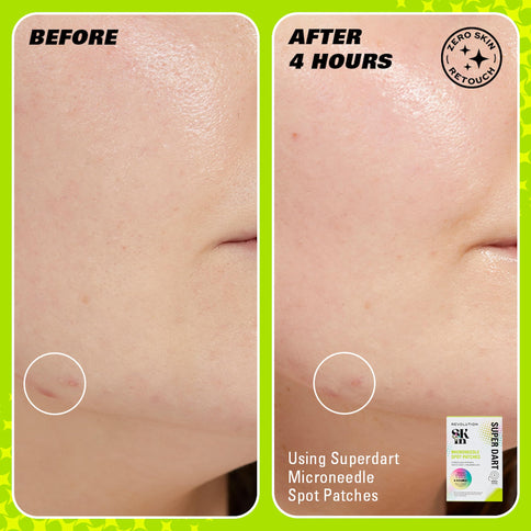 Revolution Beauty Spot Dot Go! Diskrete Pimple Patches